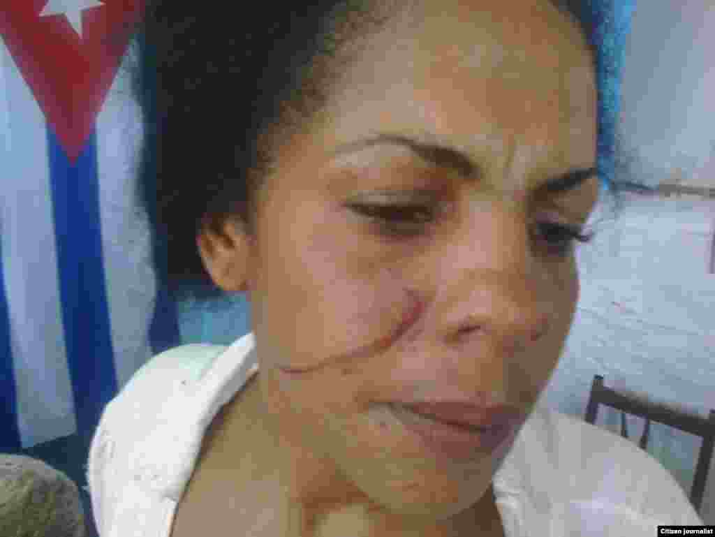  Yunaisi Carracedo, golpeada por la policía.